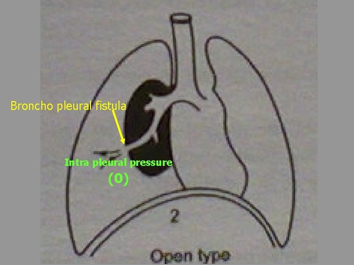 Broncho pleural fistula Intra pleural pressure (0) 