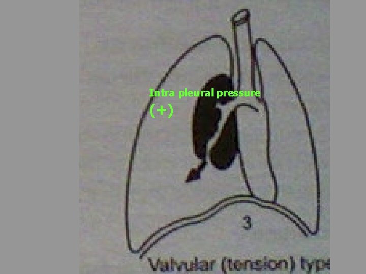 Intra pleural pressure (+) 