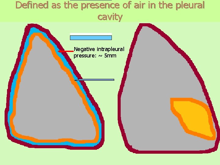 Defined as the presence of air in the pleural cavity Negative intrapleural pressure: ~