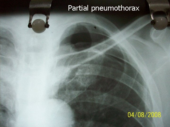 Partial pneumothorax 