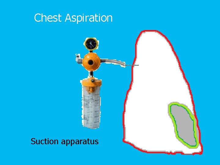 Chest Aspiration Suction apparatus 