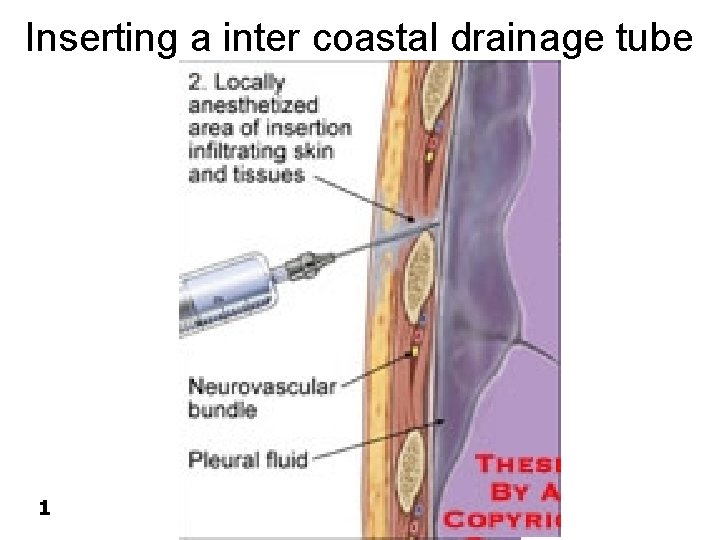 Inserting a inter coastal drainage tube 1 