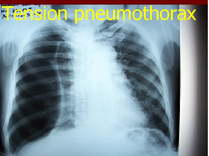 Tension pneumothorax 