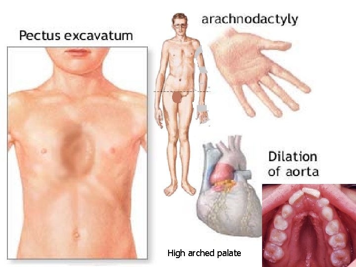 High arched palate 