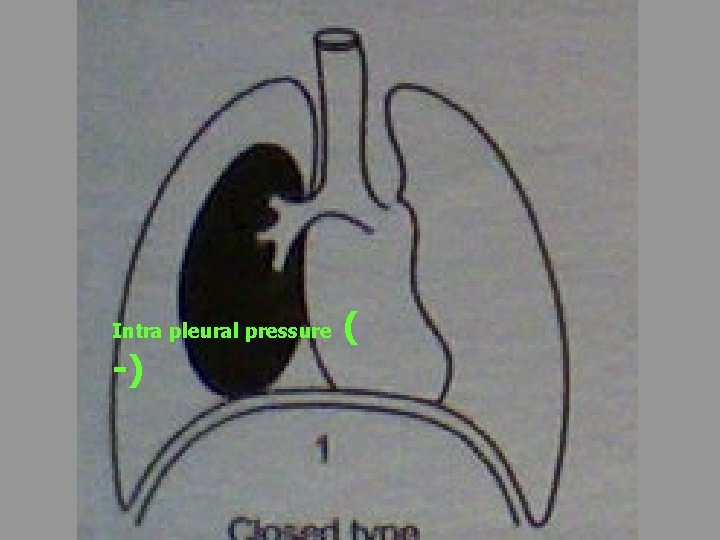 Intra pleural pressure -) ( 