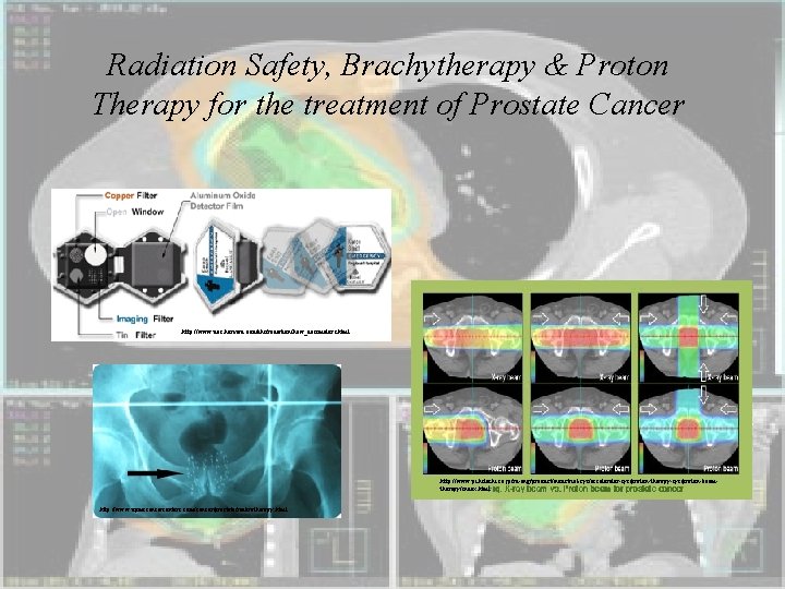 Radiation Safety, Brachytherapy & Proton Therapy for the treatment of Prostate Cancer http: //www.