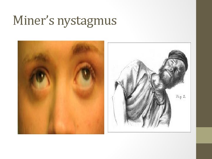 Miner’s nystagmus 