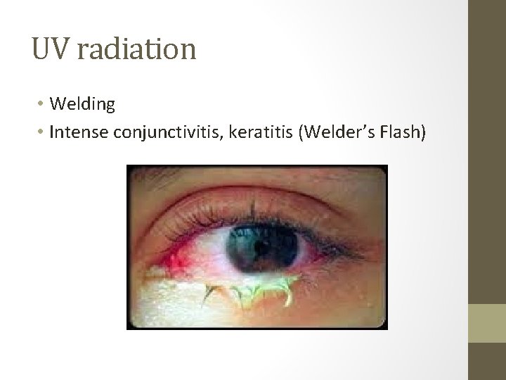 UV radiation • Welding • Intense conjunctivitis, keratitis (Welder’s Flash) 