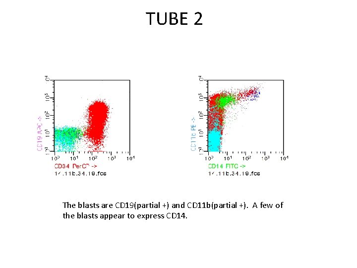 TUBE 2 The blasts are CD 19(partial +) and CD 11 b(partial +). A