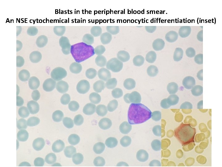 Blasts in the peripheral blood smear. An NSE cytochemical stain supports monocytic differentiation (inset)