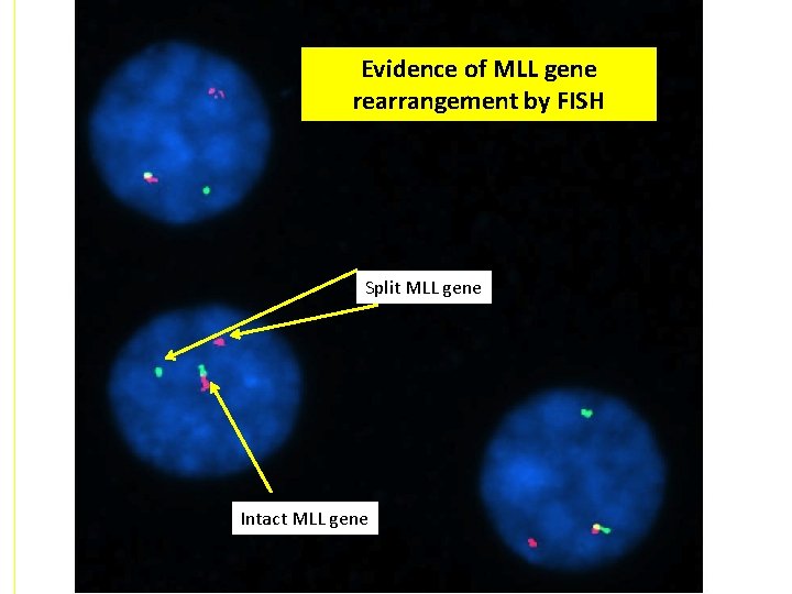 Evidence of MLL gene rearrangement by FISH Split MLL gene Intact MLL gene 