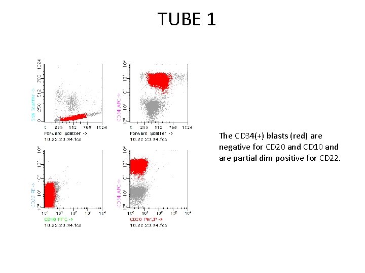 TUBE 1 The CD 34(+) blasts (red) are negative for CD 20 and CD