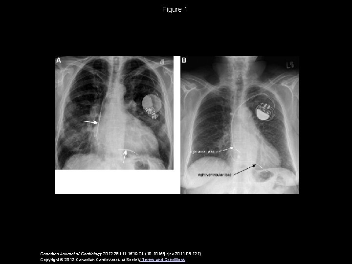 Figure 1 Canadian Journal of Cardiology 2012 28141 -151 DOI: (10. 1016/j. cjca. 2011.