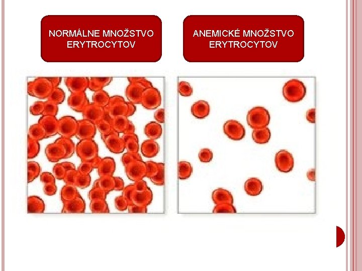 NORMÁLNE MNOŽSTVO ERYTROCYTOV ANEMICKÉ MNOŽSTVO ERYTROCYTOV 