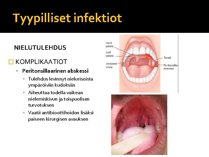 Tyypilliset infektiot NIELUTULEHDUS � KOMPLIKAATIOT Peritonsillaarinen abskessi ▪ Tulehdus levinnyt nielurisoista ympäröiviin kudoksiin ▪