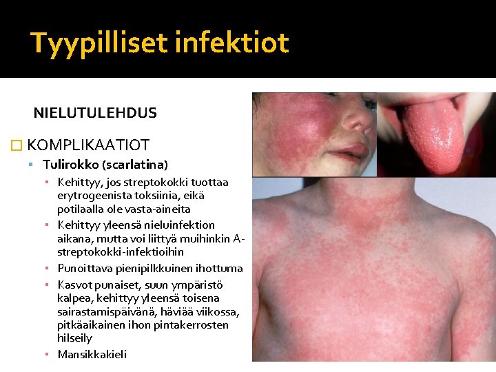 Tyypilliset infektiot NIELUTULEHDUS � KOMPLIKAATIOT Tulirokko (scarlatina) ▪ Kehittyy, jos streptokokki tuottaa erytrogeenista toksiinia,