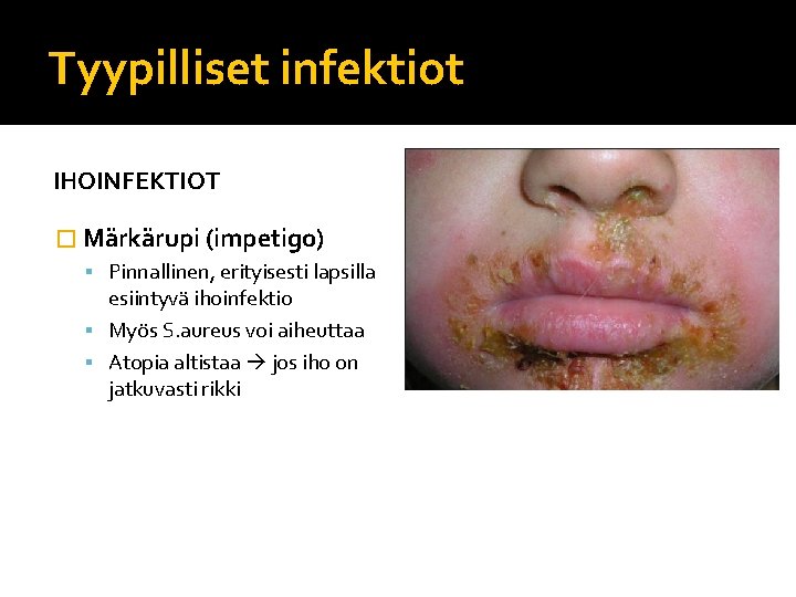 Tyypilliset infektiot IHOINFEKTIOT � Märkärupi (impetigo) Pinnallinen, erityisesti lapsilla esiintyvä ihoinfektio Myös S. aureus