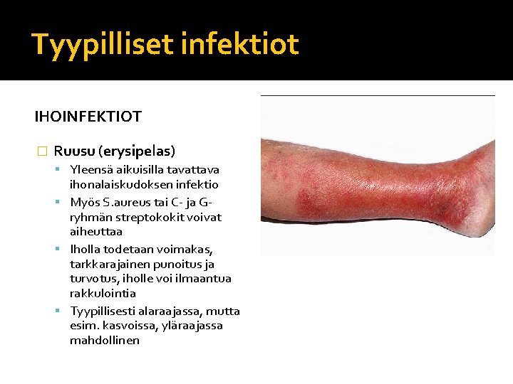 Tyypilliset infektiot IHOINFEKTIOT � Ruusu (erysipelas) Yleensä aikuisilla tavattava ihonalaiskudoksen infektio Myös S. aureus