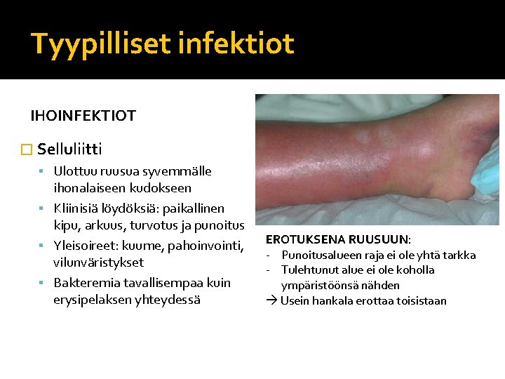 Tyypilliset infektiot IHOINFEKTIOT � Selluliitti Ulottuu ruusua syvemmälle ihonalaiseen kudokseen Kliinisiä löydöksiä: paikallinen kipu,