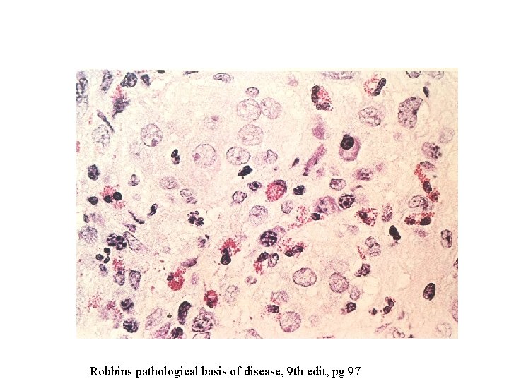 Robbins pathological basis of disease, 9 th edit, pg 97 