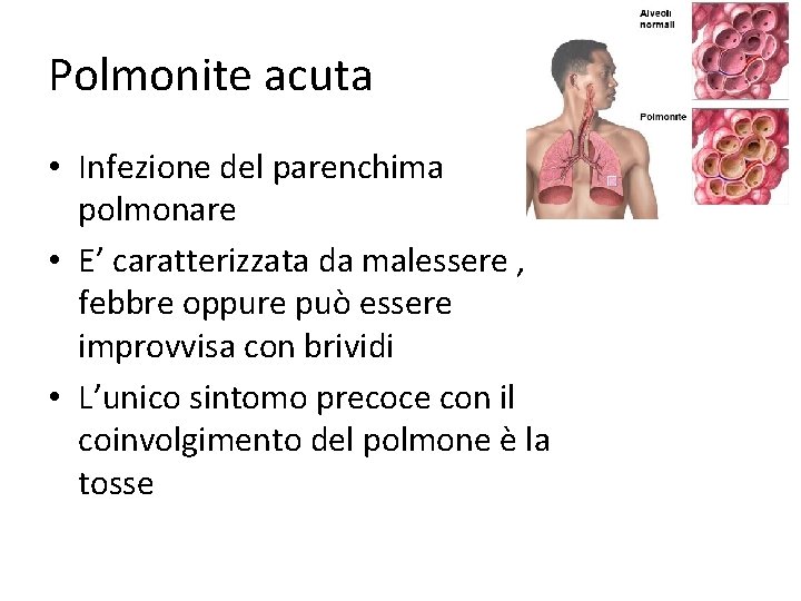 Polmonite acuta • Infezione del parenchima polmonare • E’ caratterizzata da malessere , febbre