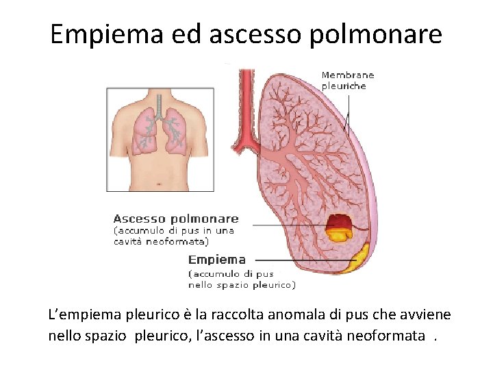 Empiema ed ascesso polmonare L’empiema pleurico è la raccolta anomala di pus che avviene