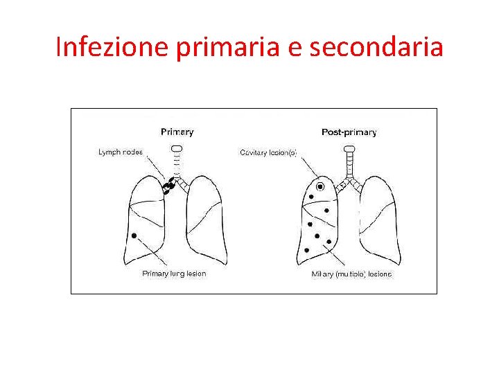 Infezione primaria e secondaria 