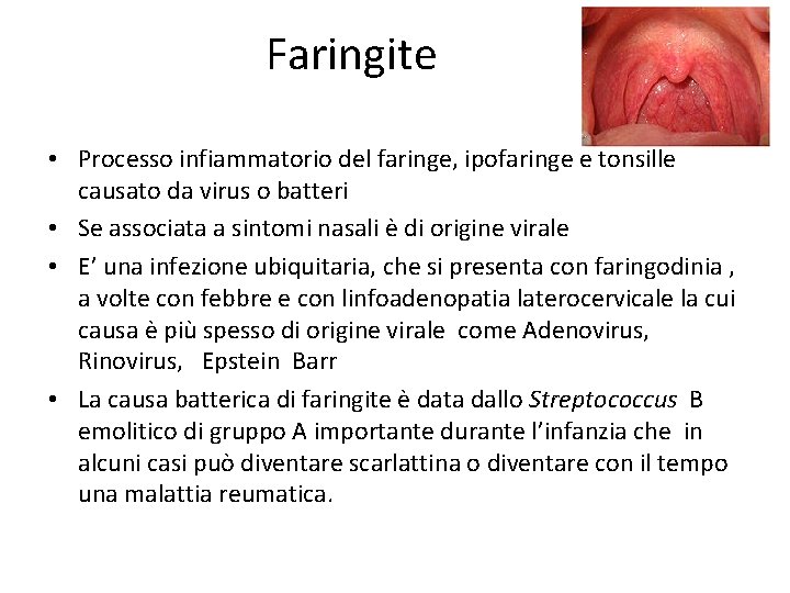 Faringite • Processo infiammatorio del faringe, ipofaringe e tonsille causato da virus o batteri