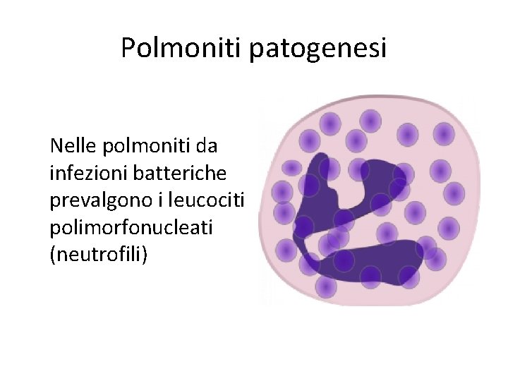 Polmoniti patogenesi Nelle polmoniti da infezioni batteriche prevalgono i leucociti polimorfonucleati (neutrofili) 