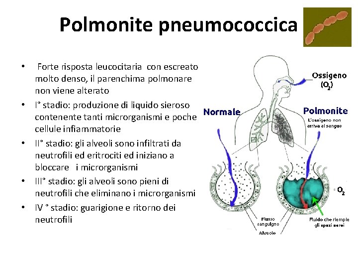 Polmonite pneumococcica • • • Forte risposta leucocitaria con escreato molto denso, il parenchima