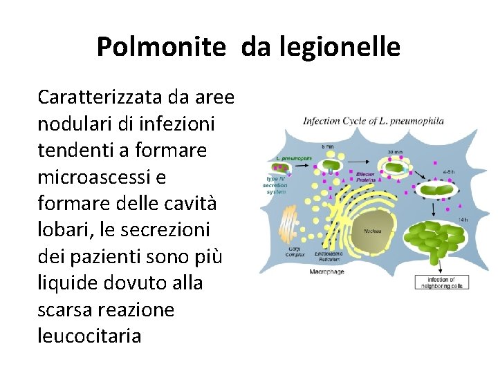 Polmonite da legionelle Caratterizzata da aree nodulari di infezioni tendenti a formare microascessi e