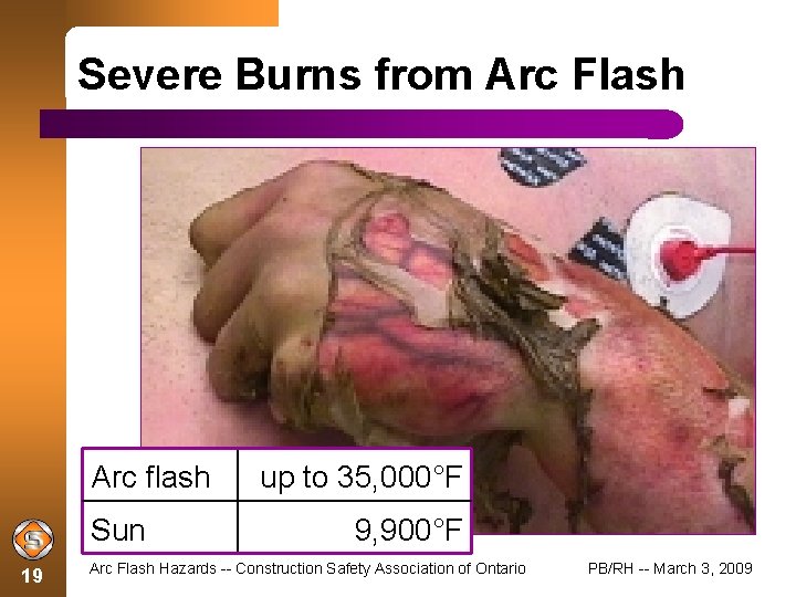 Severe Burns from Arc Flash Arc flash Sun 19 up to 35, 000°F 9,