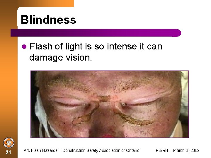 Blindness Flash of light is so intense it can damage vision. 21 Arc Flash