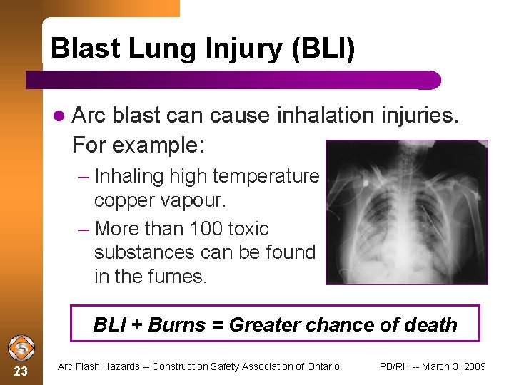 Blast Lung Injury (BLI) Arc blast can cause inhalation injuries. For example: – Inhaling