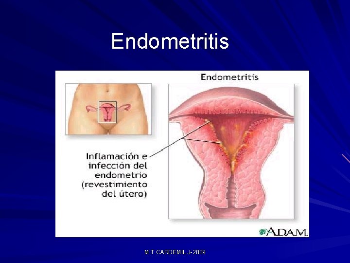 Endometritis M. T. CARDEMIL J-2009 Endometritis M. T. CARDEMIL J-2009