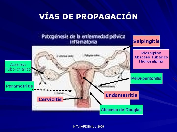 VÍAS DE PROPAGACIÓN Salpingitis Piosalpinx Absceso Tubárico Hidrosalpinx Absceso Tubo-ovárico Pelvi-peritonitis Parametritis Endometritis Cervicitis VÍAS DE PROPAGACIÓN Salpingitis Piosalpinx Absceso Tubárico Hidrosalpinx Absceso Tubo-ovárico Pelvi-peritonitis Parametritis Endometritis Cervicitis
