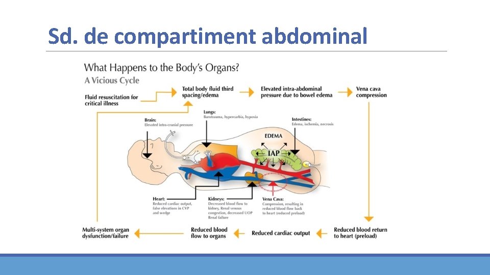 Sd. de compartiment abdominal Sd. de compartiment abdominal