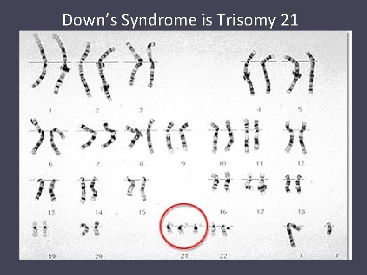 Down’s Syndrome is Trisomy 21 