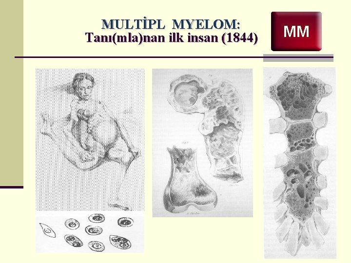 MULTİPL MYELOM: Tanı(mla)nan ilk insan (1844) MM 