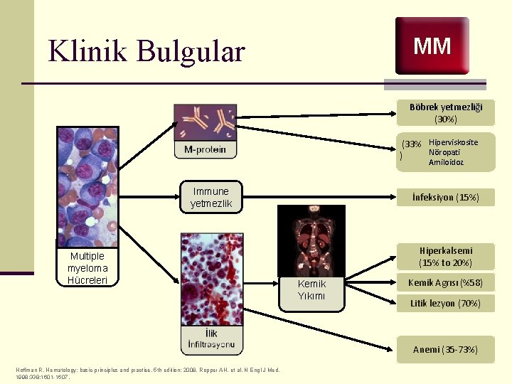 Klinik Bulgular MM Böbrek yetmezliği (30%) (33% Hiperviskosite Nöropati ) Amiloidoz Immune yetmezlik Multiple