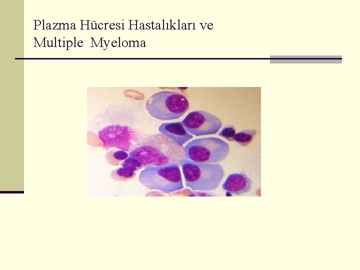 Plazma Hücresi Hastalıkları ve Multiple Myeloma 