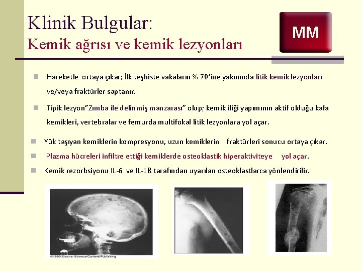 Klinik Bulgular: Kemik ağrısı ve kemik lezyonları n MM Hareketle ortaya çıkar; İlk teşhiste