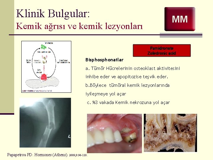 Klinik Bulgular: MM Kemik ağrısı ve kemik lezyonları Pamidronate Zoledronic acid Bisphonatlar a. Tümör