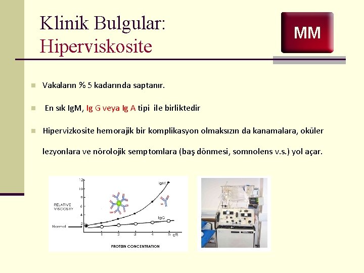 Klinik Bulgular: Hiperviskosite MM n Vakaların % 5 kadarında saptanır. n En sık Ig.