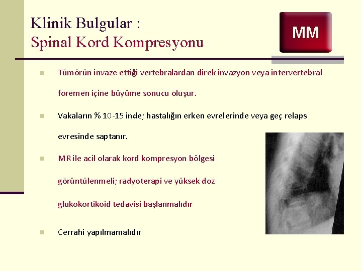 Klinik Bulgular : Spinal Kord Kompresyonu n MM Tümörün invaze ettiği vertebralardan direk invazyon