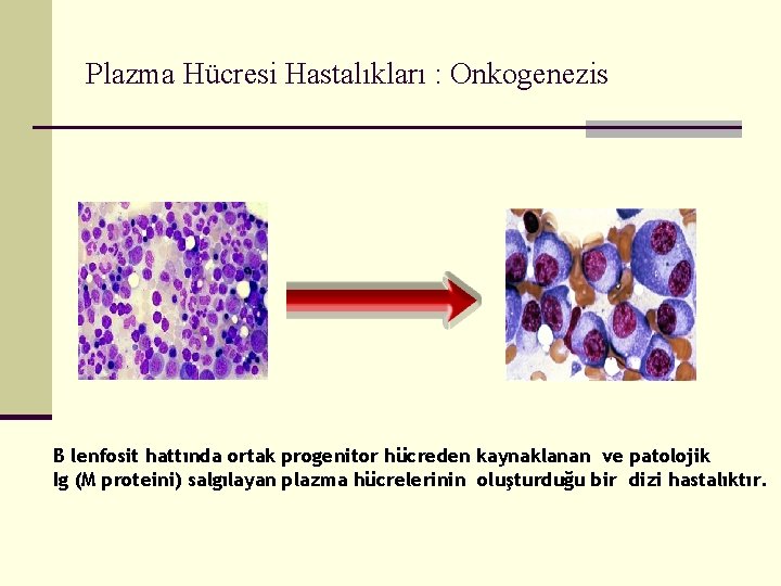 Plazma Hücresi Hastalıkları : Onkogenezis B lenfosit hattında ortak progenitor hücreden kaynaklanan ve patolojik