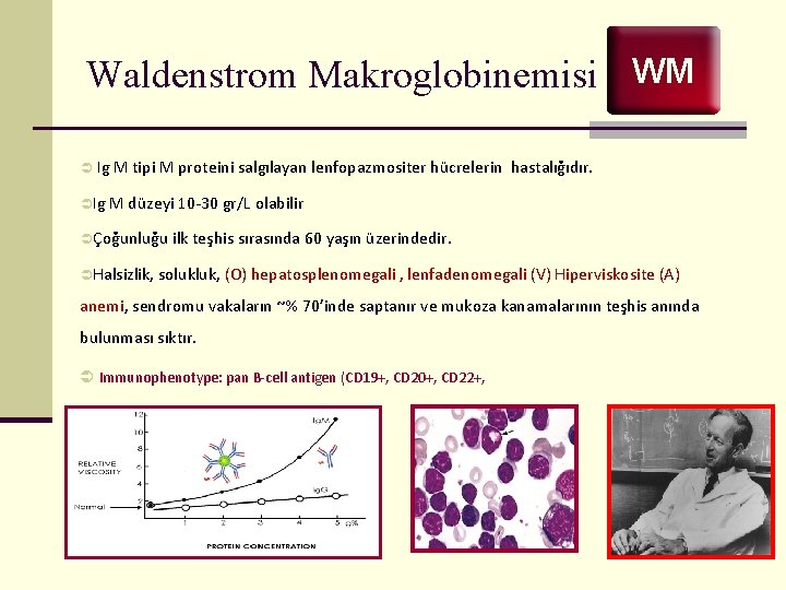 Waldenstrom Makroglobinemisi WM Ü Ig M tipi M proteini salgılayan lenfopazmositer hücrelerin hastalığıdır. ÜIg