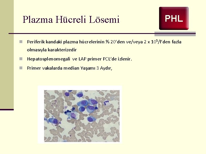 Plazma Hücreli Lösemi PHL n Periferik kandaki plazma hücrelerinin % 20’den ve/veya 2 x