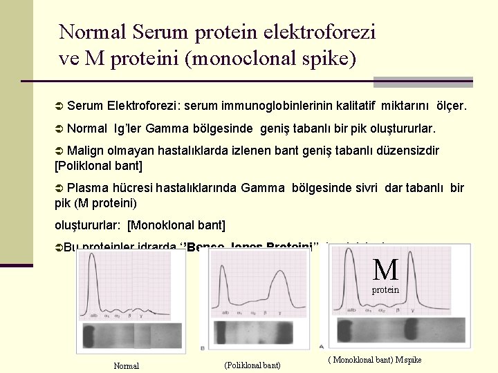 Normal Serum protein elektroforezi ve M proteini (monoclonal spike) Ü Serum Elektroforezi: serum immunoglobinlerinin