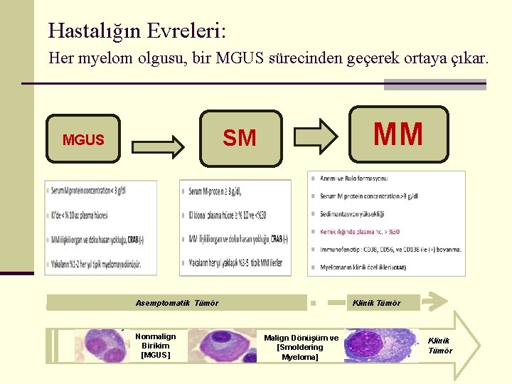 Hastalığın Evreleri: Her myelom olgusu, bir MGUS sürecinden geçerek ortaya çıkar. MM SM MGUS